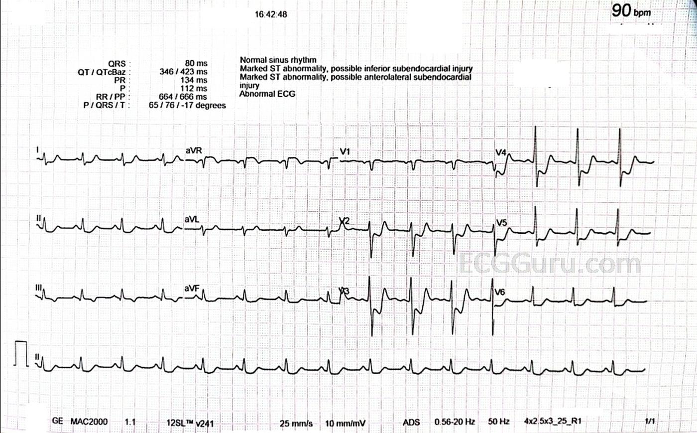 severe-triple-vessel-disease-ecg-guru-instructor-resources